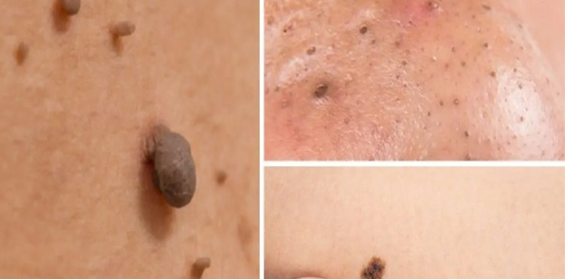 Best Way Skin Tag Remover vs Mole Removal Solution: Which One Should You Buy?