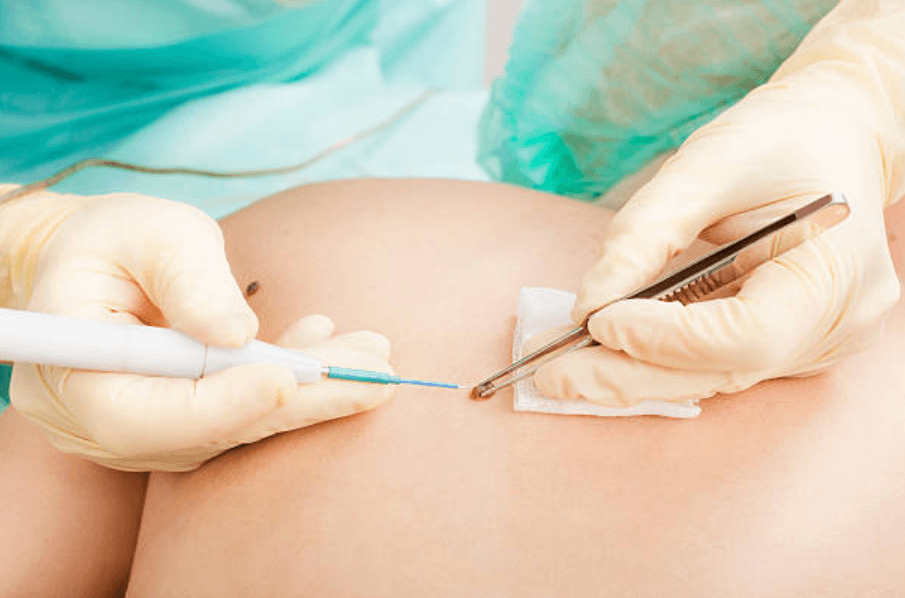 Realistic Price Expectations for Mole Removal Services in Essex